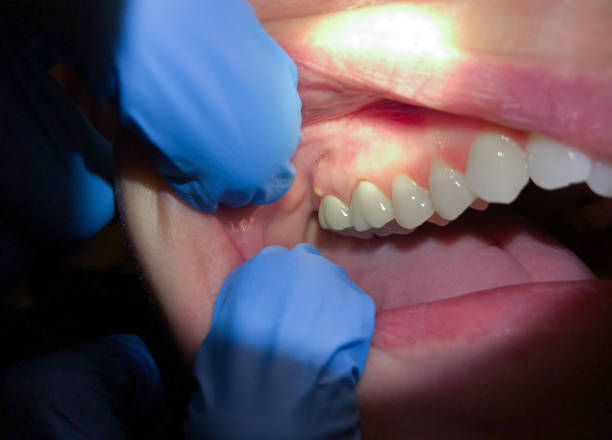 Best Emergency Care for Gum Disease in Pablo, MT
